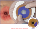 Hydrofera Blue Bacteriostatic Adhesive Foam Ostomy Dressing W/O Border, 2.5In Square